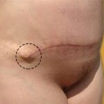 Dog Ears After Tummy Tuck