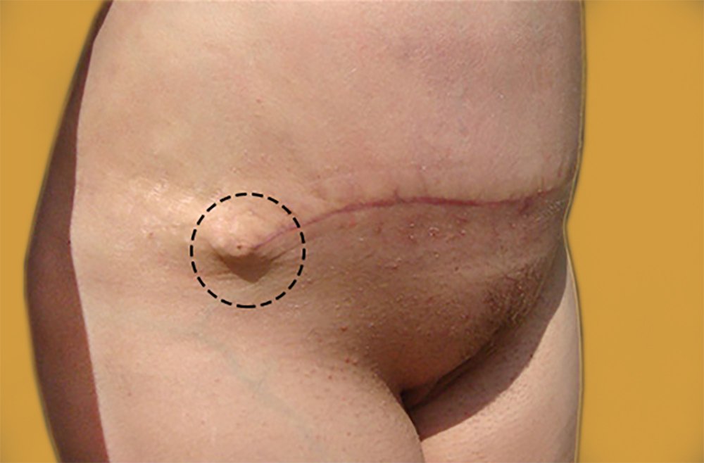 Dog Ears After Tummy Tuck